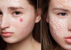 acne on women's face